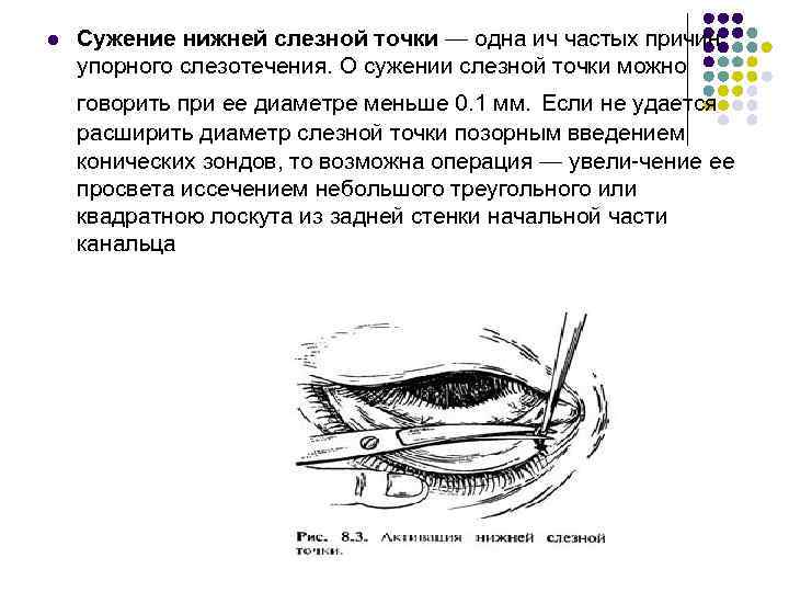 l Сужение нижней слезной точки — одна ич частых причин упорного слезотечения. О сужении