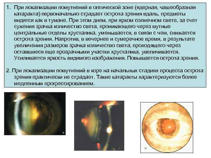 1. При локализации помутнений в оптической зоне (ядерная, чашеобразная катаракта) первоначально страдает острота зрения