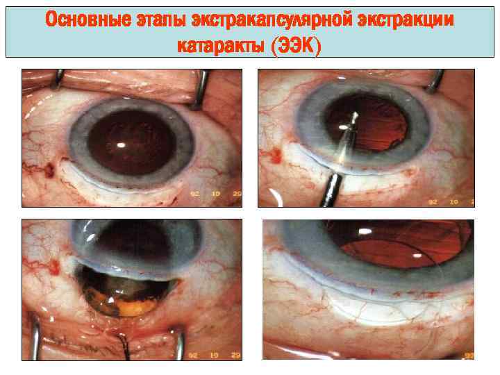 Основные этапы экстракапсулярной экстракции катаракты (ЭЭК) 