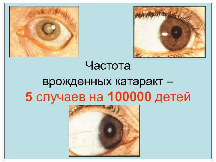 Частота врожденных катаракт – 5 случаев на 100000 детей 