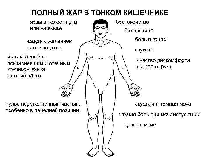 ПОЛНЫЙ ЖАР В ТОНКОМ КИШЕЧНИКЕ язвы в полости рта или на языке жажда с