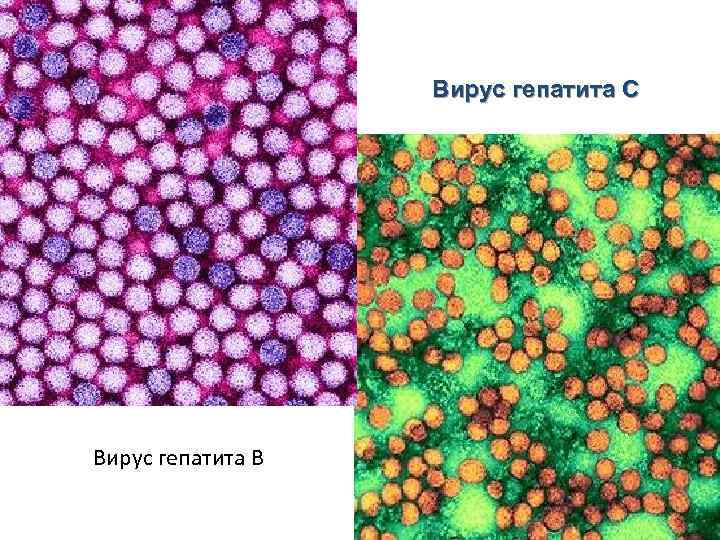 Вирус гепатита С Вирус гепатита В 