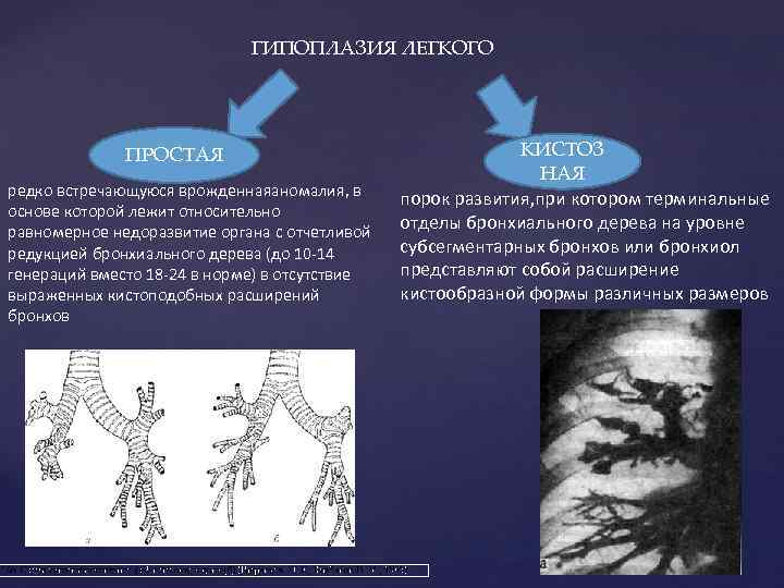 ГИПОПЛАЗИЯ ЛЕГКОГО ПРОСТАЯ редко встречающуюся врожденнаяаномалия, в основе которой лежит относительно равномерное недоразвитие органа