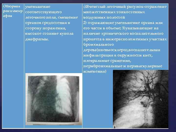 Обзорная уменьшение рентгеногр соответствующего афия легочного поля, смещение органов средостения в сторону поражения, высокое