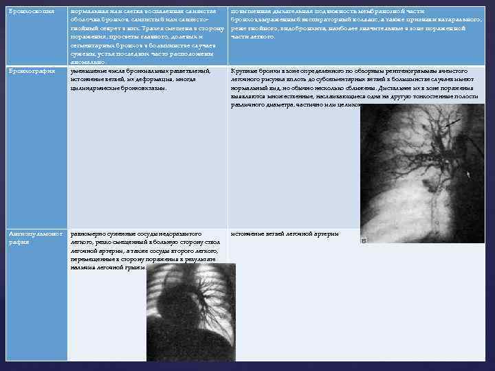 Бронхоскопия Бронхография Ангиопульмоног рафия нормальная или слегка воспаленная слизистая оболочка бронхов, слизистый или слизистогнойный