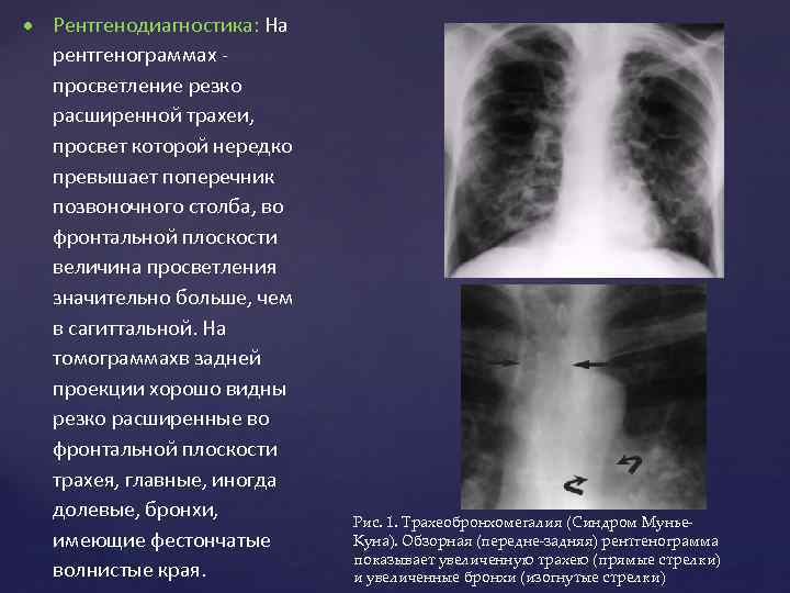  Рентгенодиагностика: На рентгенограммах просветление резко расширенной трахеи, просвет которой нередко превышает поперечник позвоночного
