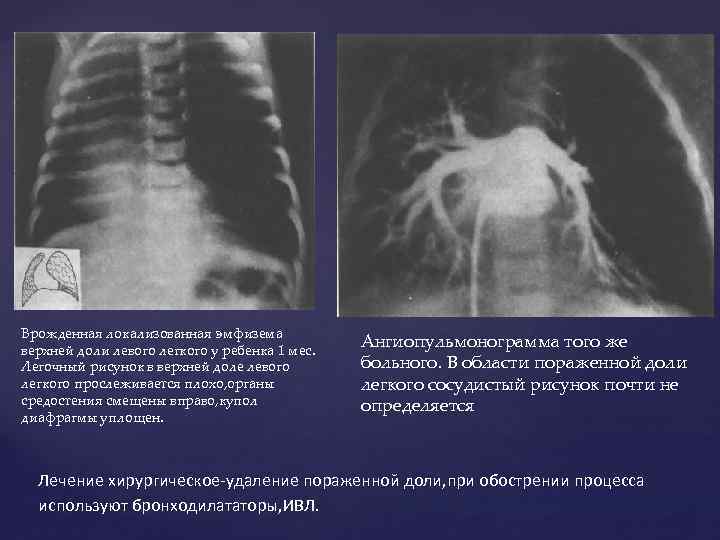 Врожденная лобарная эмфизема клиника рентгенологическая картина принципы лечения
