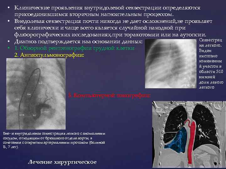  • Клинические проявления внутридолевой секвестрации определяются присоединившимся вторичным нагноительным процессом. • Внедолевая секвестрация