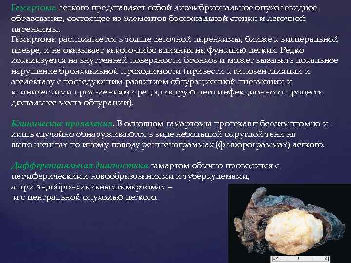 Гамартома легкого представляет собой дизэмбриональное опухолевидное образование, состоящее из элементов бронхиальной стенки и легочной