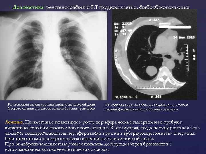 Диагностика: рентгенография и КТ грудной клетки, фибробронхоскопия Рентгенологическая картина гамартомы верхней доли (второго сегмента)