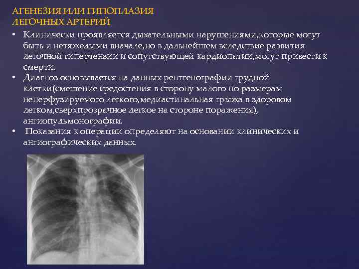 АГЕНЕЗИЯ ИЛИ ГИПОПЛАЗИЯ ЛЕГОЧНЫХ АРТЕРИЙ • Клинически проявляется дыхательными нарушениями, которые могут быть и