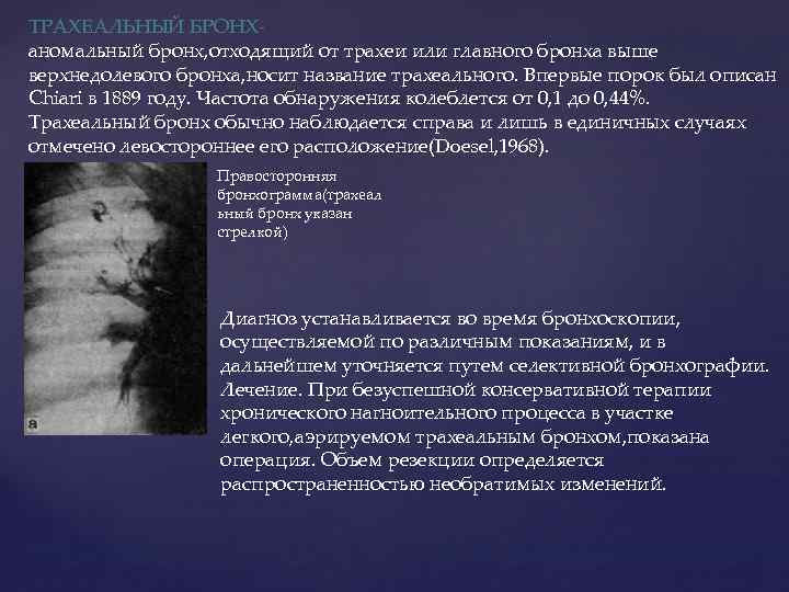 ТРАХЕАЛЬНЫЙ БРОНХаномальный бронх, отходящий от трахеи или главного бронха выше верхнедолевого бронха, носит название