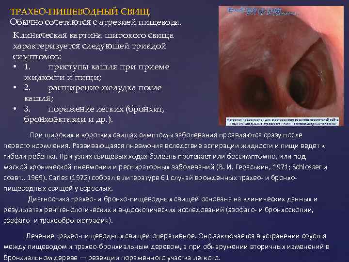 ТРАХЕО-ПИЩЕВОДНЫЙ СВИЩ. Обычно сочетаются с атрезией пищевода. Клиническая картина широкого свища характеризуется следующей триадой