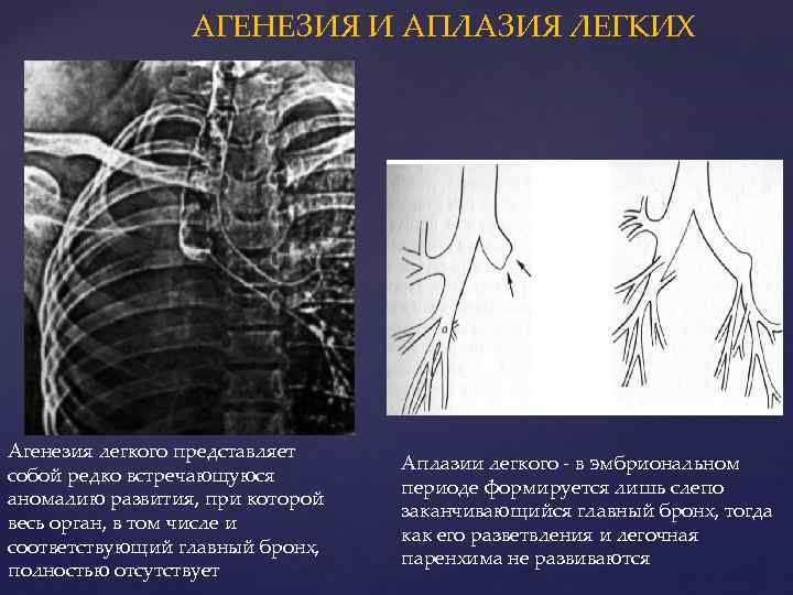 АГЕНЕЗИЯ И АПЛАЗИЯ ЛЕГКИХ Агенезия легкого представляет собой редко встречающуюся аномалию развития, при которой