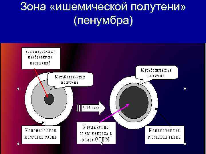 Зона «ишемической полутени» (пенумбра) 