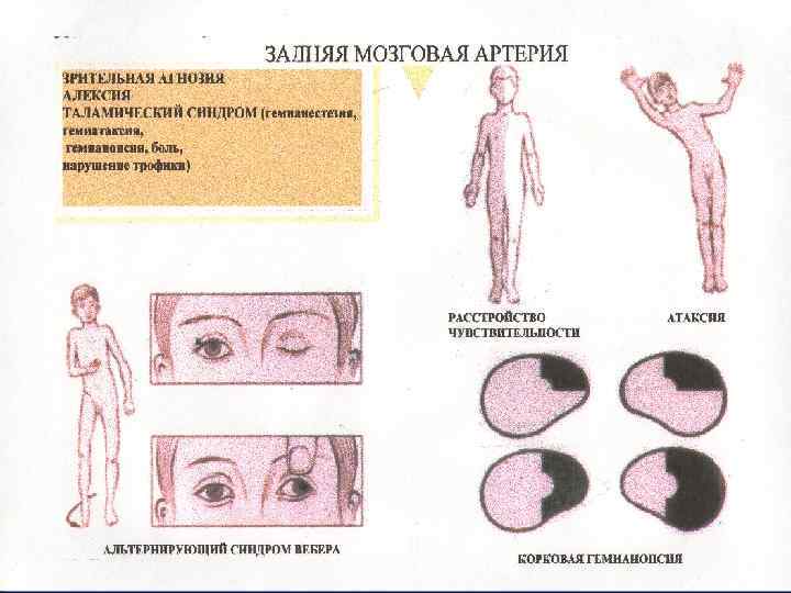 Онмк с левосторонним гемипарезом карта вызова скорой помощи