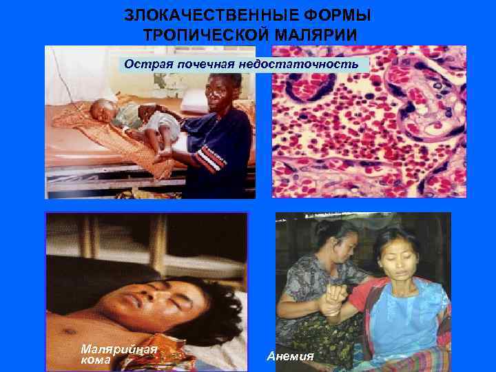ЗЛОКАЧЕСТВЕННЫЕ ФОРМЫ ТРОПИЧЕСКОЙ МАЛЯРИИ Острая почечная недостаточность Малярийная кома Анемия 