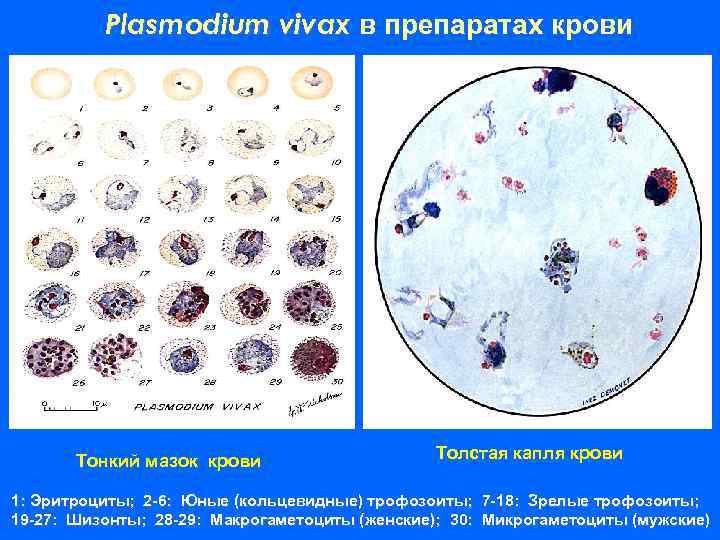 Малярийный плазмодий в толстой капле фото