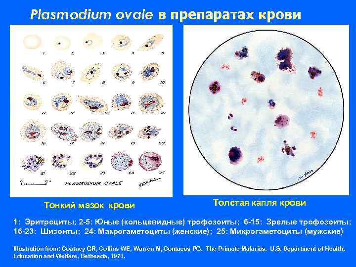 Plasmodium ovale в препаратах крови Тонкий мазок крови Толстая капля крови 1: Эритроциты; 2