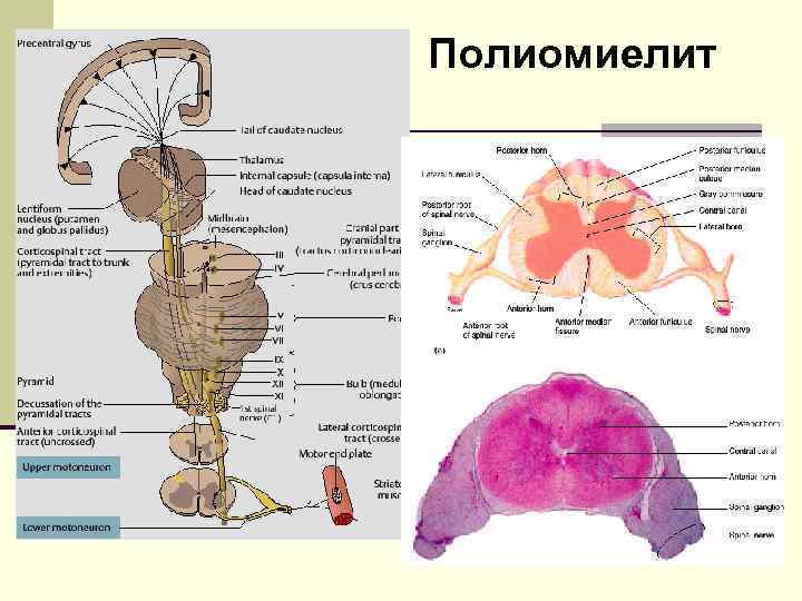 Полиомиелит 