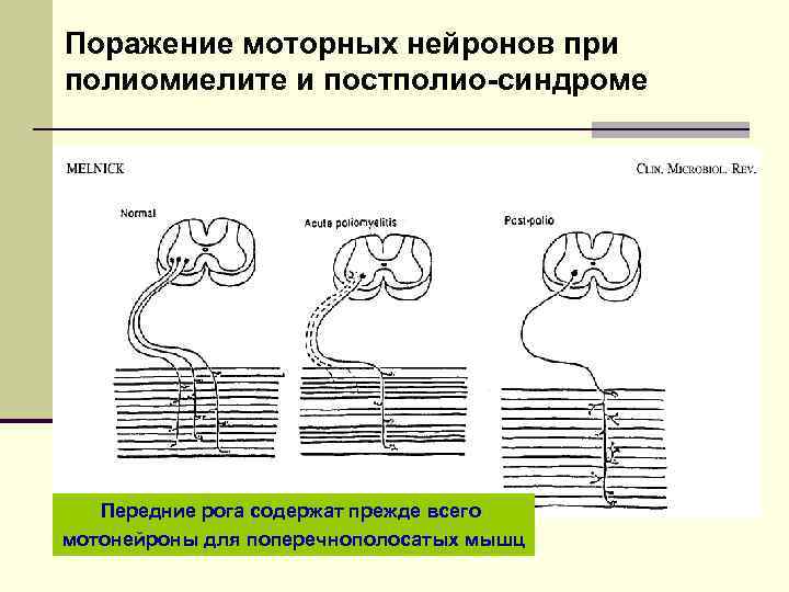 Поражение моторных нейронов при полиомиелите и постполио-синдроме Передние рога содержат прежде всего мотонейроны для