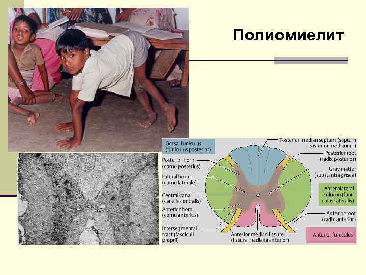 Полиомиелит 