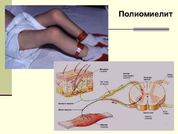 Полиомиелит 