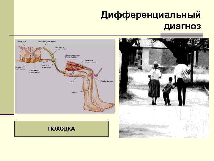 Дифференциальный диагноз ПОХОДКА 