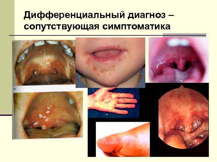 Дифференциальный диагноз – сопутствующая симптоматика 