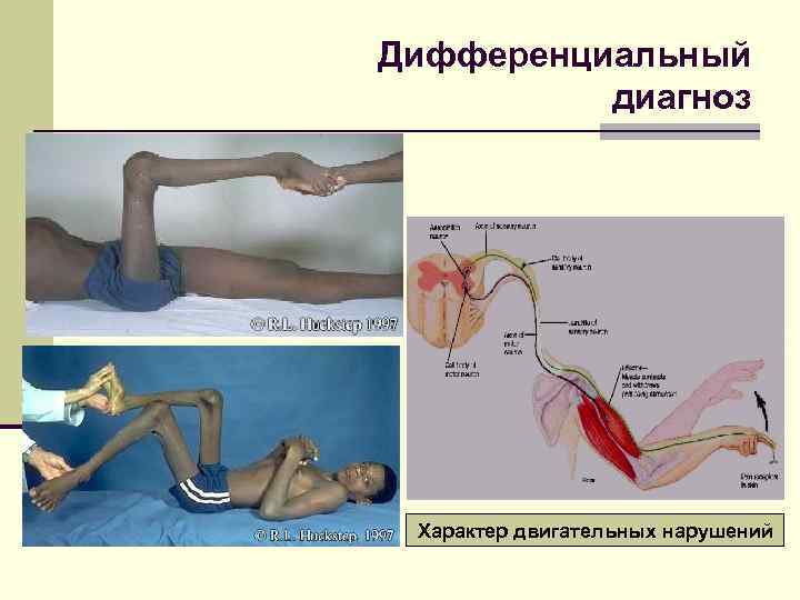 Дифференциальный диагноз Характер двигательных нарушений 