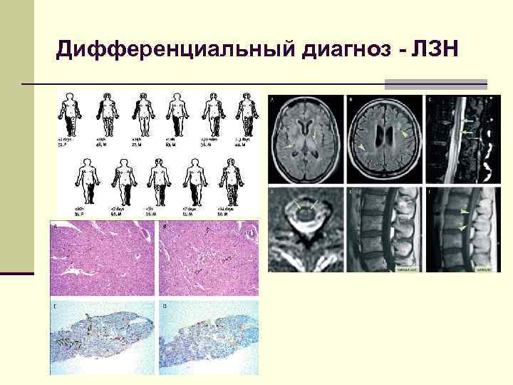 Дифференциальный диагноз - ЛЗН 