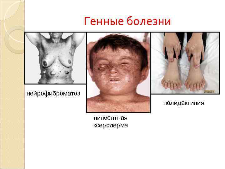 Генные болезни нейрофиброматоз полидактилия пигментная ксеродерма 