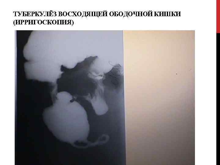 ТУБЕРКУЛЁЗ ВОСХОДЯЩЕЙ ОБОДОЧНОЙ КИШКИ (ИРРИГОСКОПИЯ) 