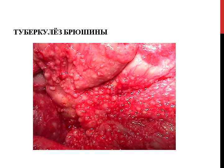 ТУБЕРКУЛЁЗ БРЮШИНЫ 