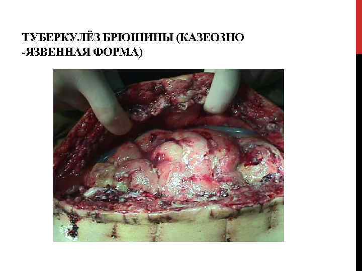 ТУБЕРКУЛЁЗ БРЮШИНЫ (КАЗЕОЗНО -ЯЗВЕННАЯ ФОРМА) 