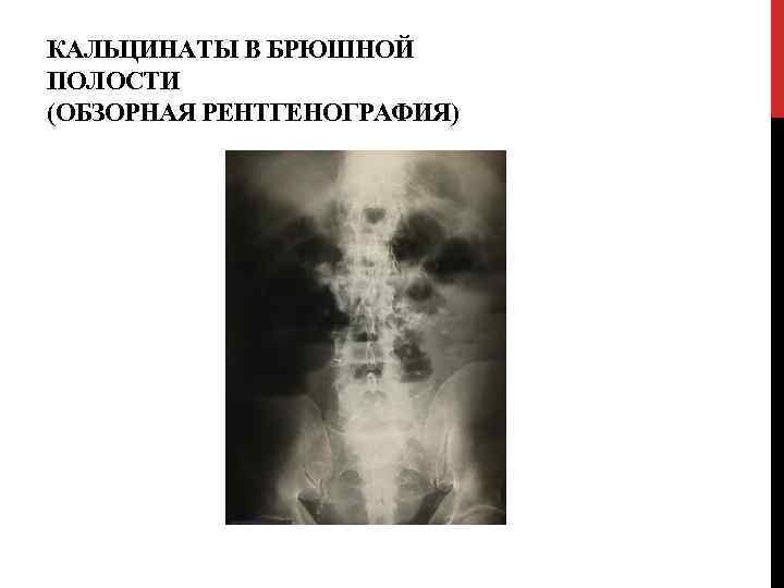 КАЛЬЦИНАТЫ В БРЮШНОЙ ПОЛОСТИ (ОБЗОРНАЯ РЕНТГЕНОГРАФИЯ) 