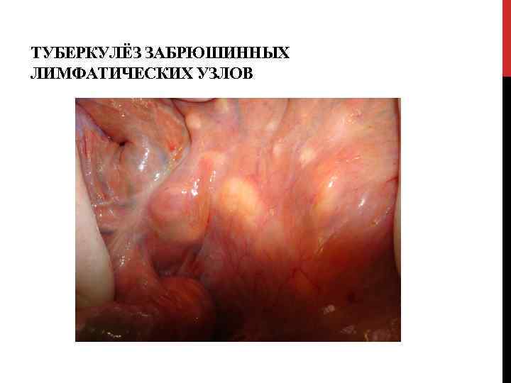 ТУБЕРКУЛЁЗ ЗАБРЮШИННЫХ ЛИМФАТИЧЕСКИХ УЗЛОВ 