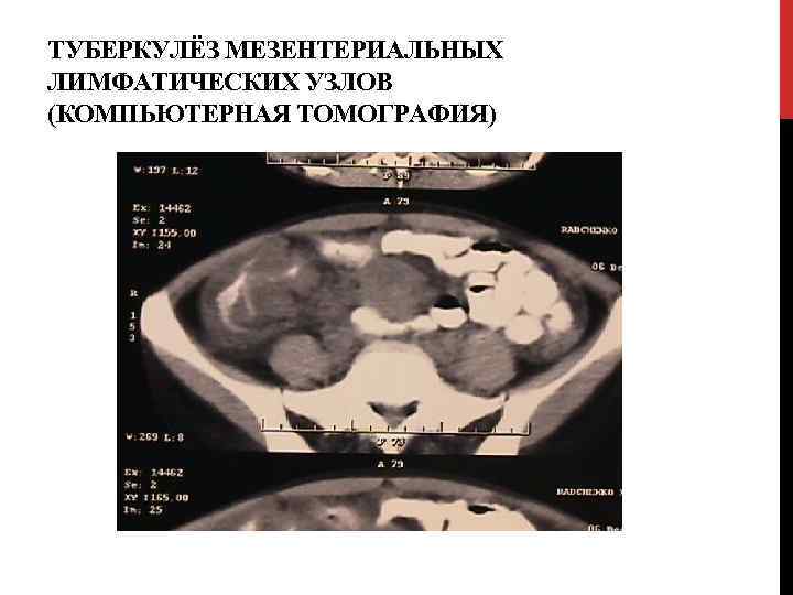 ТУБЕРКУЛЁЗ МЕЗЕНТЕРИАЛЬНЫХ ЛИМФАТИЧЕСКИХ УЗЛОВ (КОМПЬЮТЕРНАЯ ТОМОГРАФИЯ) 