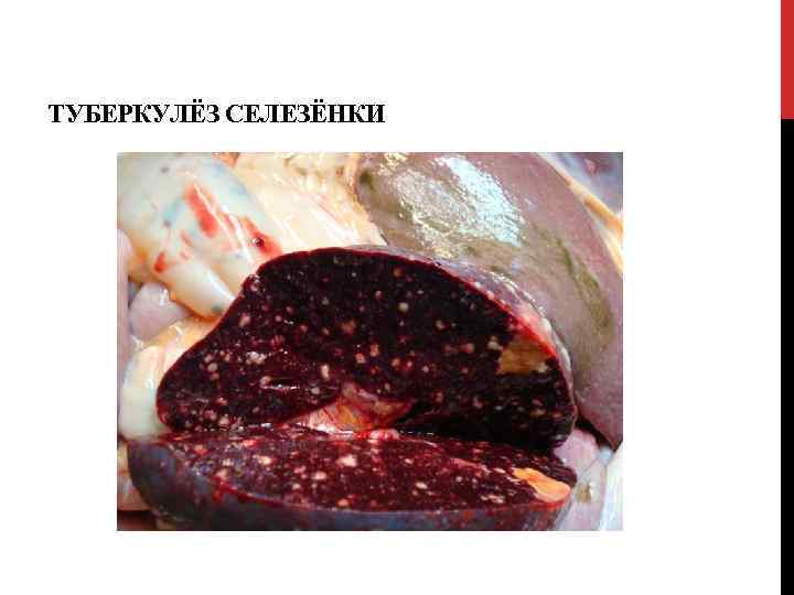 ТУБЕРКУЛЁЗ СЕЛЕЗЁНКИ 