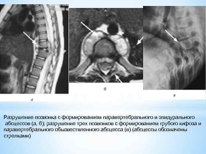 Разрушение позвонка с формированием паравертебрального и эпидурального абсцессов (а, б); разрушение трех позвонков с
