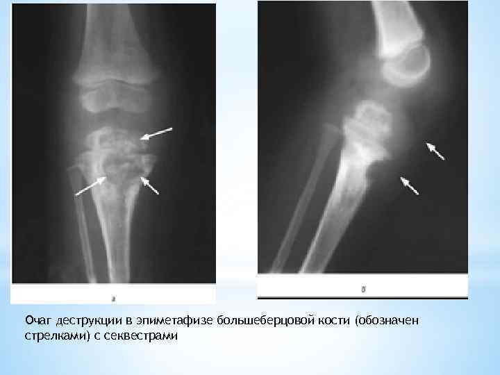 Очаг деструкции в эпиметафизе большеберцовой кости (обозначен стрелками) с секвестрами 