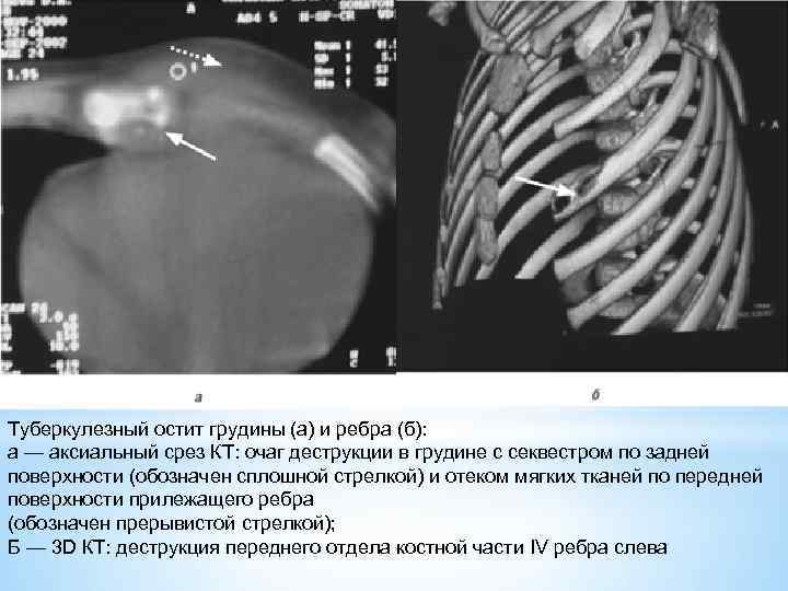 Туберкулезный остит грудины (а) и ребра (б): а — аксиальный срез КТ: очаг деструкции