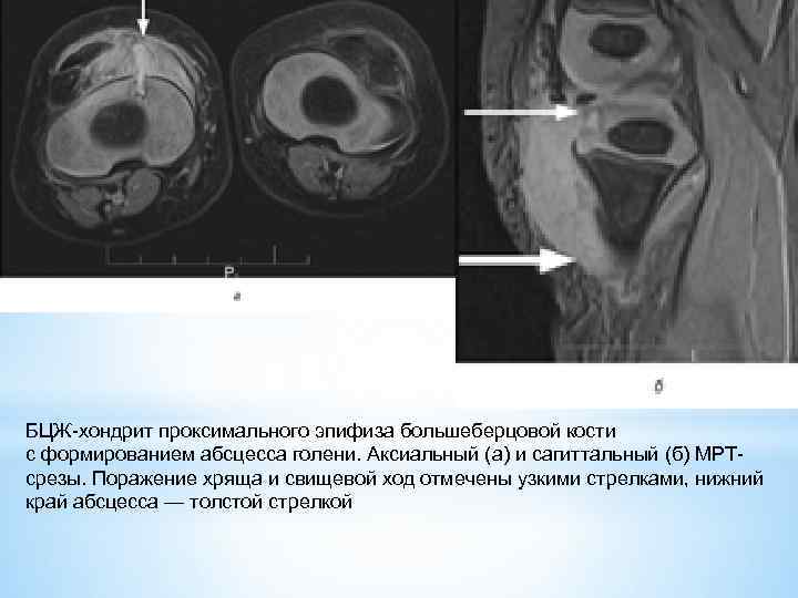БЦЖ хондрит проксимального эпифиза большеберцовой кости с формированием абсцесса голени. Аксиальный (а) и сагиттальный