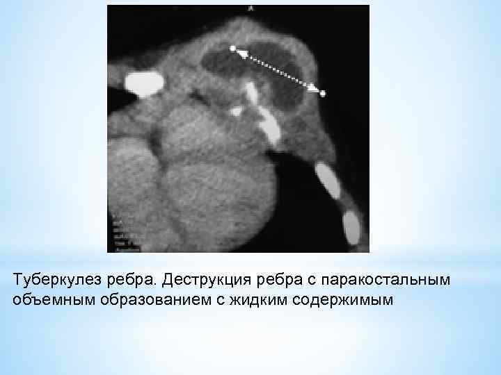 Туберкулез ребра. Деструкция ребра с паракостальным объемным образованием с жидким содержимым 