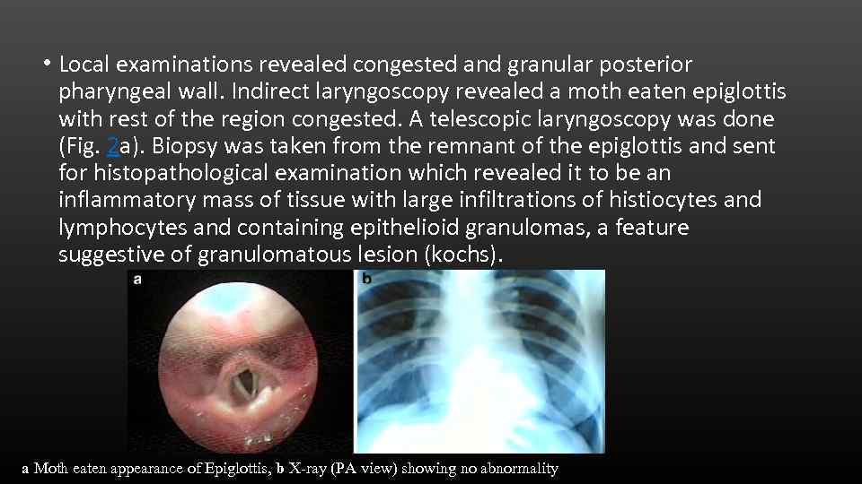  • Local examinations revealed congested and granular posterior pharyngeal wall. Indirect laryngoscopy revealed