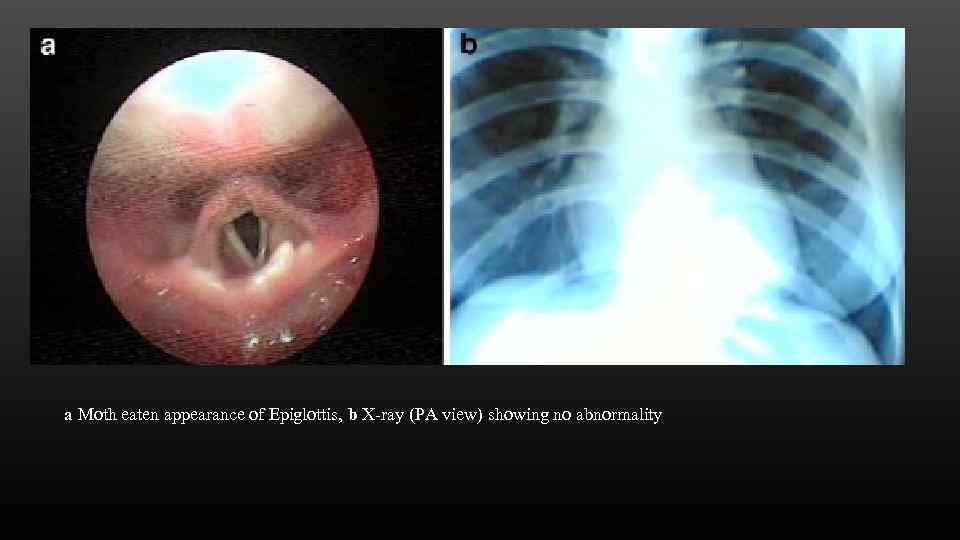 a Moth eaten appearance of Epiglottis, b X-ray (PA view) showing no abnormality 