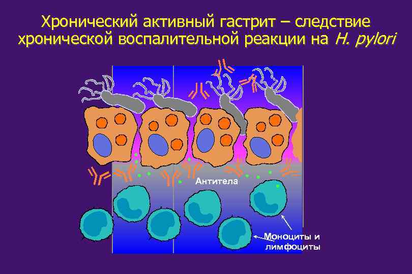 Хронический активный гастрит – следствие хронической воспалительной реакции на H. pylori Антитела Моноциты и