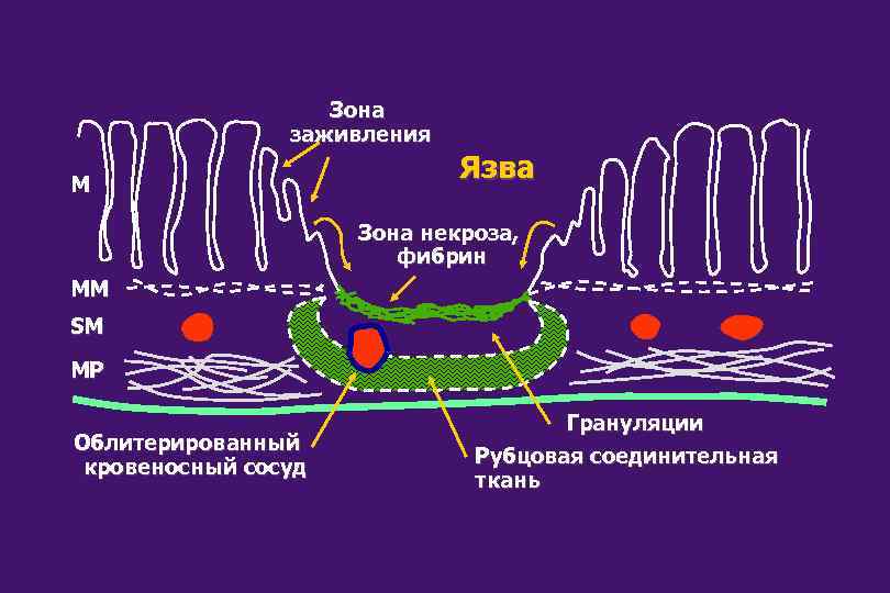 Зона заживления M Язва Зона некроза, фибрин MM SM MP Облитерированный кровеносный сосуд Грануляции