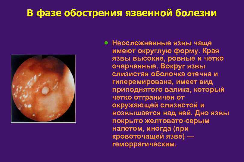 В фазе обострения язвенной болезни · Неосложненные язвы чаще имеют округлую форму. Края язвы
