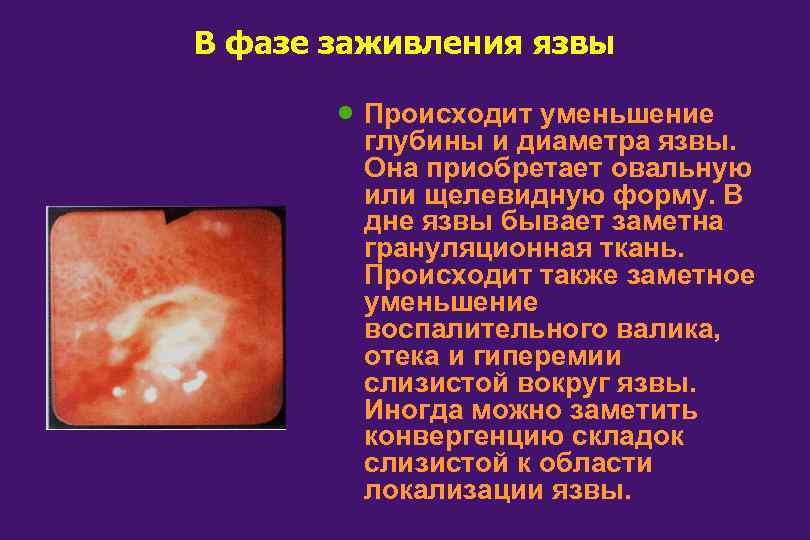 В фазе заживления язвы · Происходит уменьшение глубины и диаметра язвы. Она приобретает овальную
